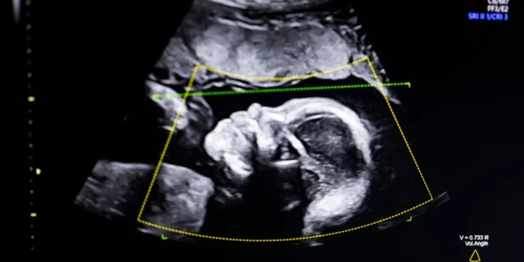 Ultratingulli fetal me AI merr miratimin e FDA-së, BioticsAI hap një kapitull të ri